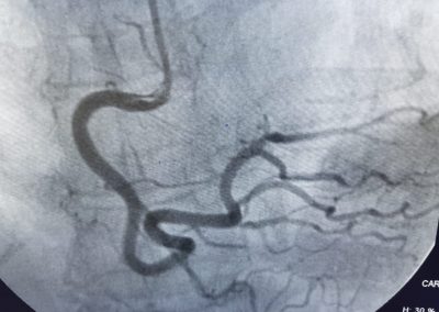 Cardiac Catheterization and Percutaneous Coronary Angioplasty